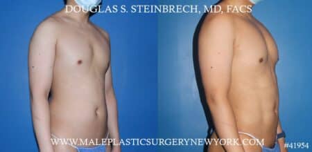 Liposuction with body banking to augment the pecs and shoulders by Dr. Steinbrech