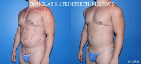 Liposuction with body banking to enhance the pecs and glutes by Dr. Steinbrech.