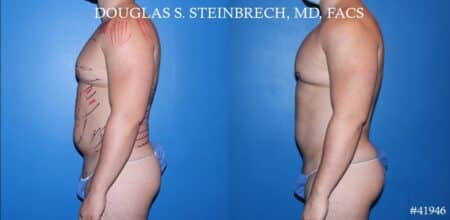 Liposuction with body banking to enhance the pecs and glutes by Dr. Steinbrech.