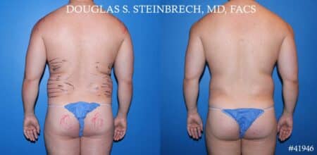 Liposuction with body banking to enhance the pecs and glutes by Dr. Steinbrech.