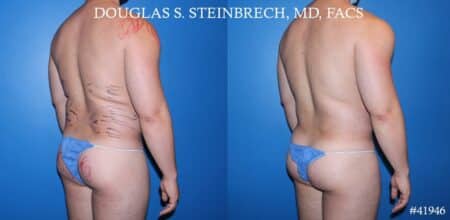 Liposuction with body banking to enhance the pecs and glutes by Dr. Steinbrech.