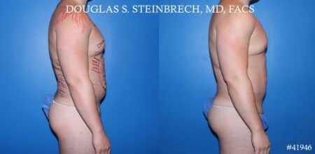 Liposuction with body banking to enhance the pecs and glutes by Dr. Steinbrech.