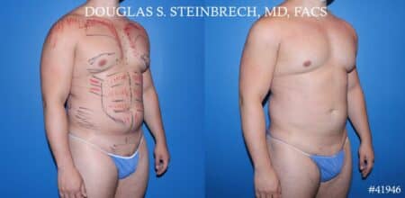 Liposuction with body banking to enhance the pecs and glutes by Dr. Steinbrech.