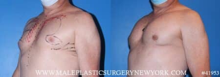 Pectoral implants to add definition to the chest by Dr. Steinbrech