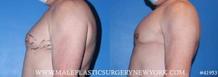 Pectoral implants to add definition to the chest by Dr. Steinbrech