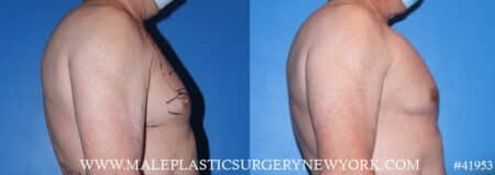 Pectoral implants to add definition to the chest by Dr. Steinbrech