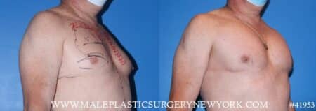 Pectoral implants to add definition to the chest by Dr. Steinbrech