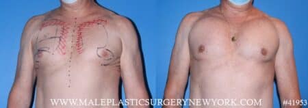 Pectoral implants to add definition to the chest by Dr. Steinbrech