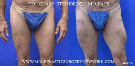 Quad augmentation to enhance the thighs by Dr. Steinbrech