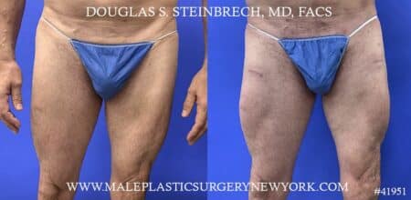 Quad augmentation to enhance the thighs by Dr. Steinbrech