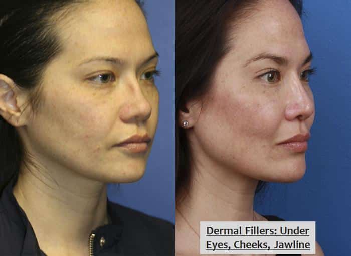 How to Make Your Face Less Flat? 6 Surgical and Non-surgical