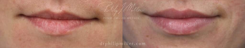 Filler to enhance the shape and volume of the lips by Dr. Miller. After treatment, lips are fuller and more defined.