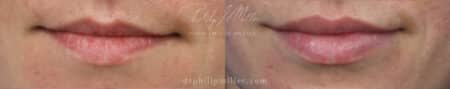 Filler to enhance the shape and volume of the lips by Dr. Miller