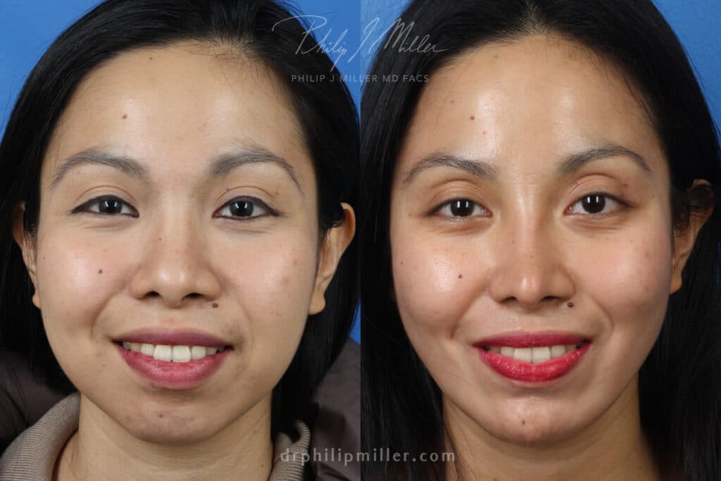 Rhinoplasty, chin implant, and fat grafting for facial enhancement by Dr. Miller. After surgery, facial contour is more proportionate and youthful.