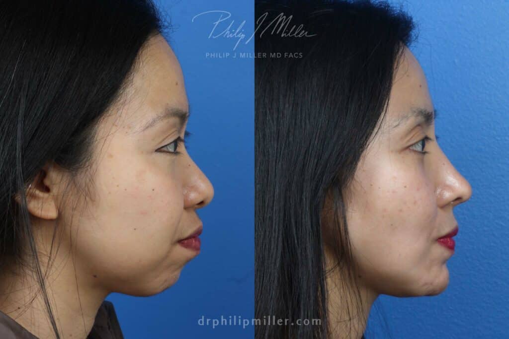 Rhinoplasty, chin implant, and fat grafting for facial enhancement by Dr. Miller. After surgery, facial contour is more proportionate and youthful.