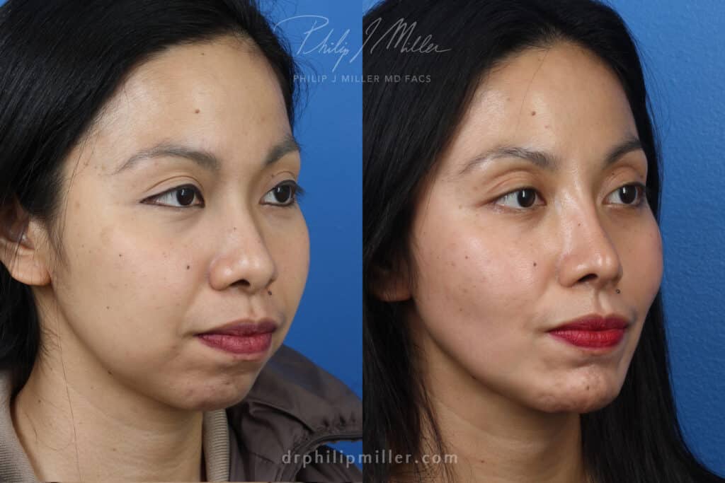 Rhinoplasty, chin implant, and fat grafting for facial enhancement by Dr. Miller. After surgery, facial contour is more proportionate and youthful.