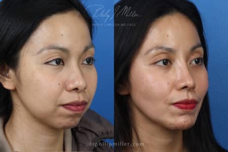 Rhinoplasty, chin implant, and fat grafting for facial enhancement by Dr. Miller