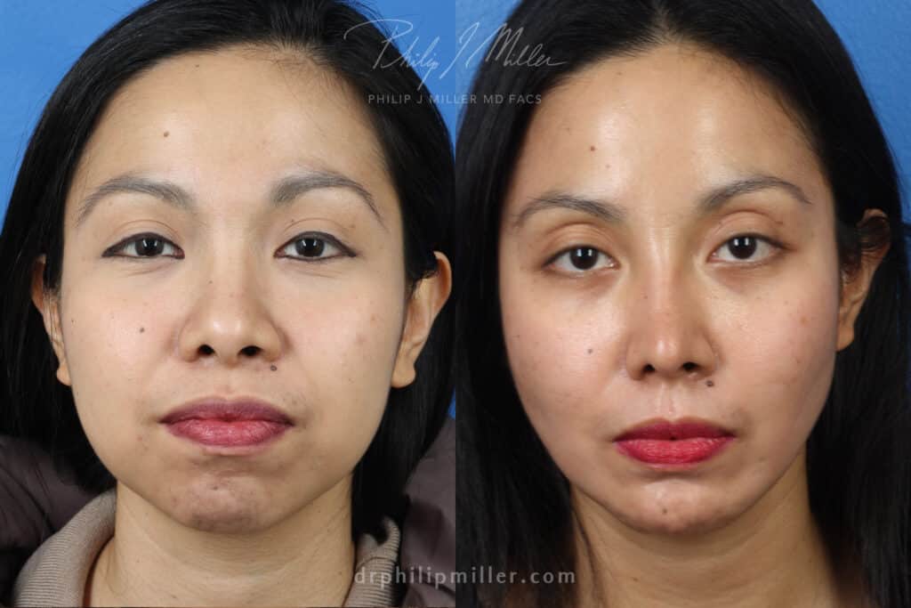 wide nostrils correction with rhinoplasty