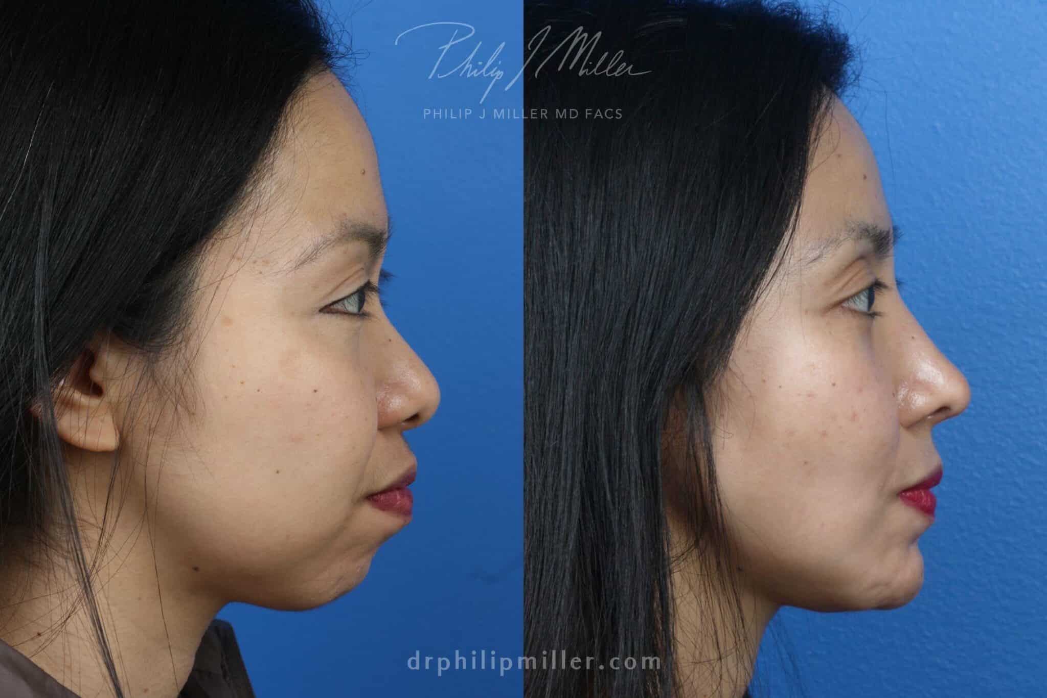 weak jawline correction on a female patient in nyc