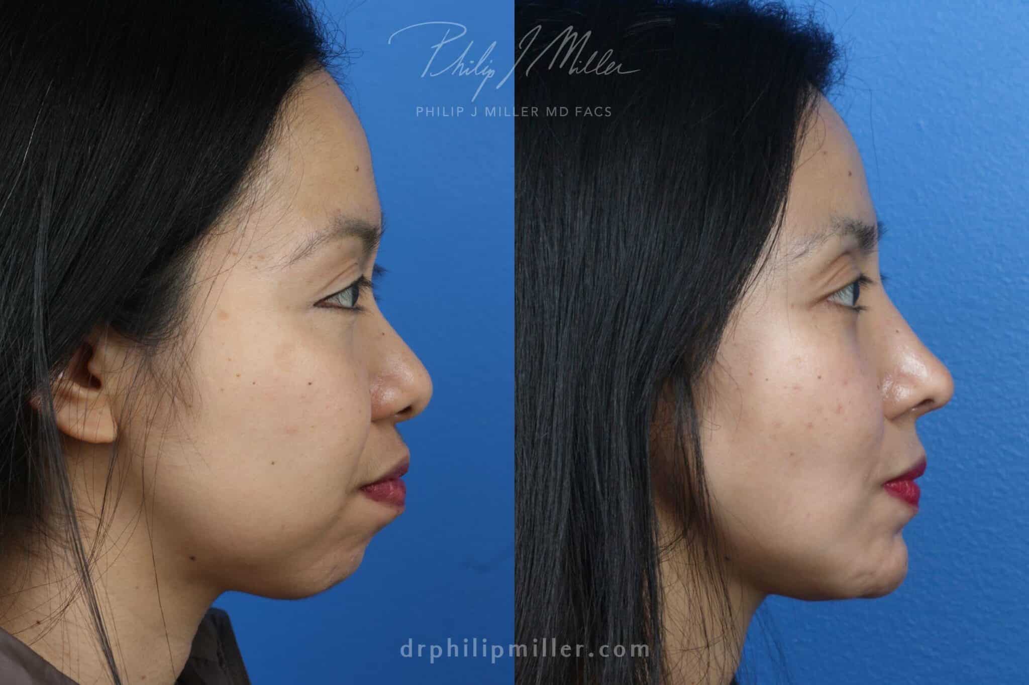 Weak Receding Jaw And Chin Correction In New York Philip Miller MD