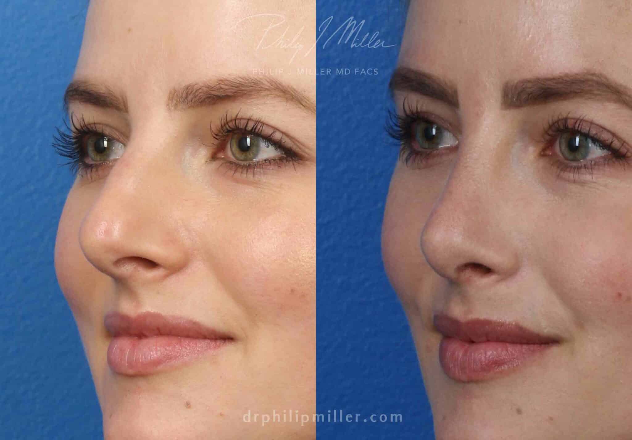 Rhinoplasty to enhance the appearance of the nose, 3 months post-op, by Dr. Miller. Surgery straightens bridge and refines tip for a more attractive profile.