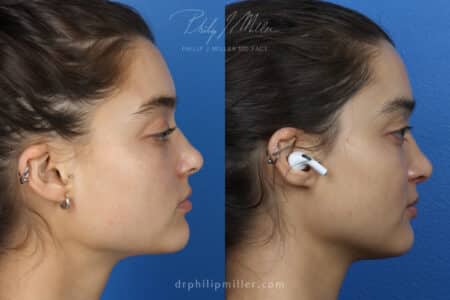 Rhinoplasty to improve the nose shape, 3 months post-op, by Dr. Miller