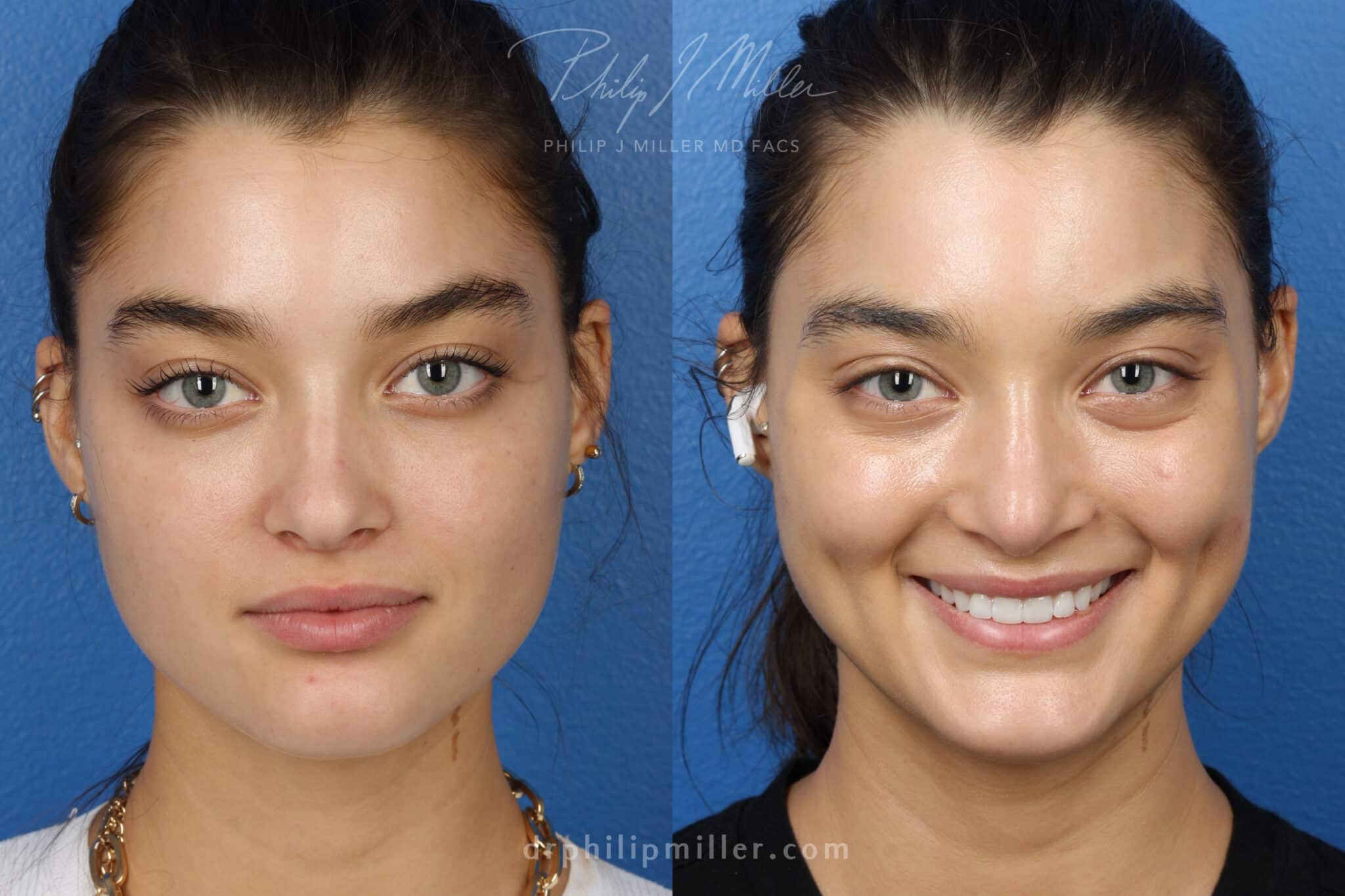 Rhinoplasty to improve the nose shape, 3 months post-op, by Dr. Miller. After surgery, nasal bridge is straighter and more refined.