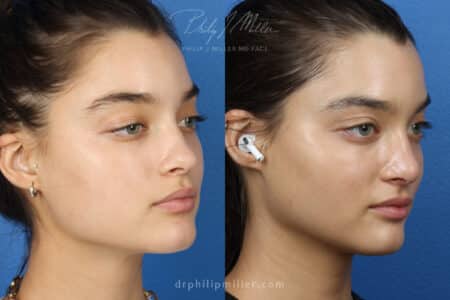 Rhinoplasty to improve the nose shape, 3 months post-op, by Dr. Miller