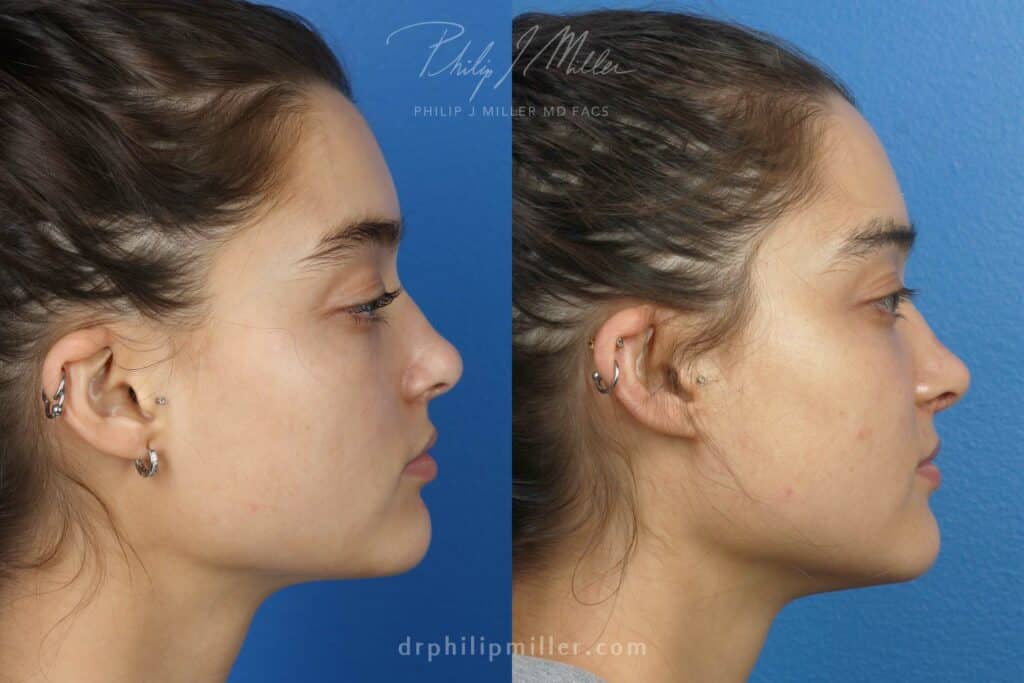 Rhinoplasty to improve the nose shape, 8 months post-op, by Dr. Miller. After surgery, nasal bridge is straighter and more refined.