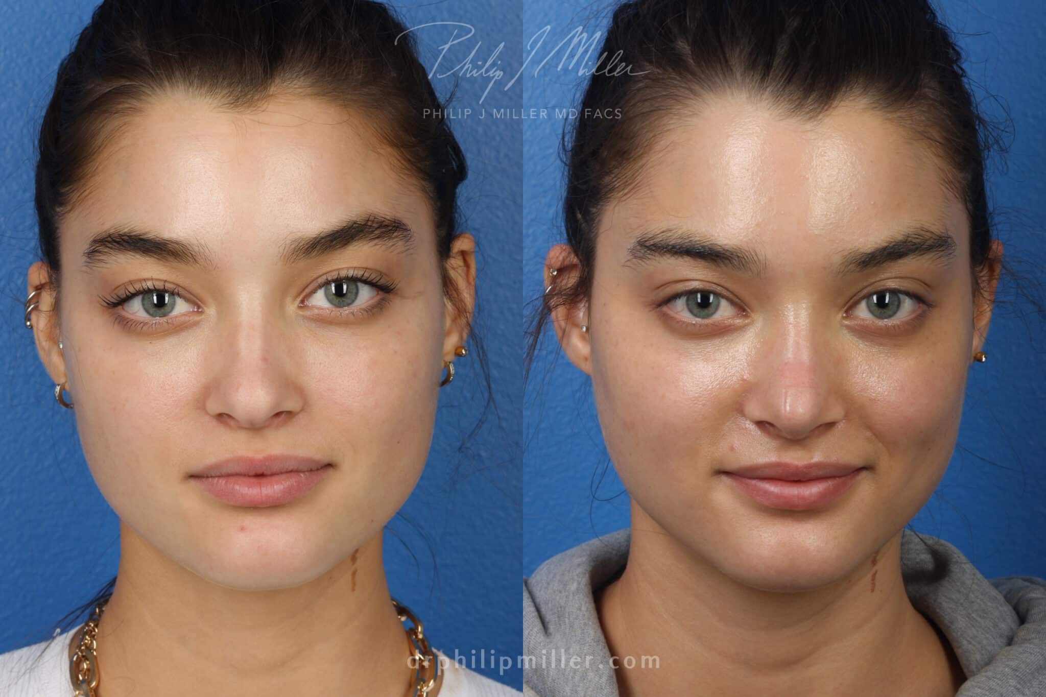 Rhinoplasty to improve the nose shape, 8 months post-op, by Dr. Miller. After surgery, nasal bridge is straighter and more refined.