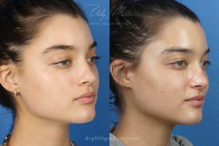 Rhinoplasty to improve the nose shape, 8 months post-op, by Dr. Miller