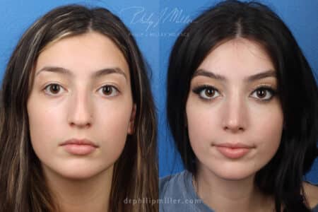 Rhinoplasty to remove nasal hump and refine tip by Dr. Miller