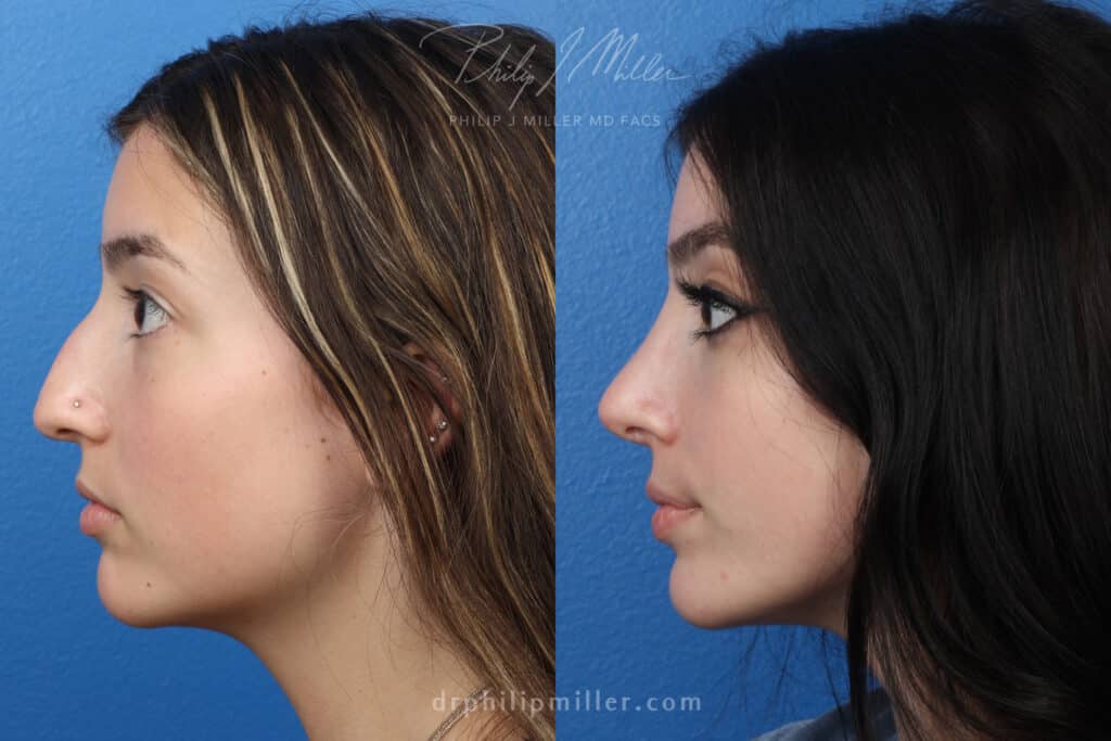 Rhinoplasty to remove nasal hump and refine tip by Dr. Miller. After surgery, dorsal hump is gone and nasal tip is slightly rotated for a more attractive profile.