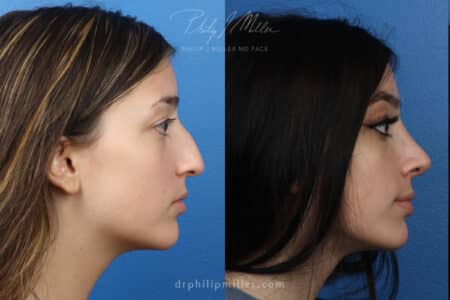 Rhinoplasty to remove nasal hump and refine tip by Dr. Miller