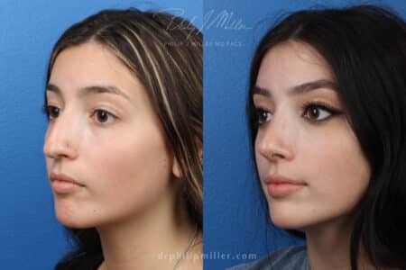 Rhinoplasty to remove nasal hump and refine tip by Dr. Miller