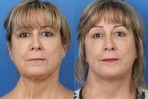 facelift before and after results on a NYC patient