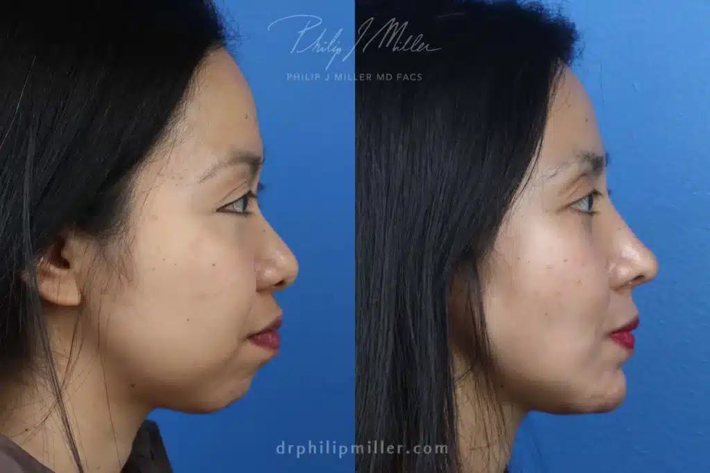 nose job before and after results in NYC