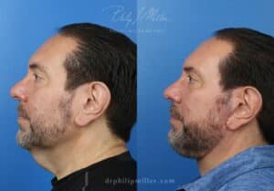 facelift surgery results in NYC