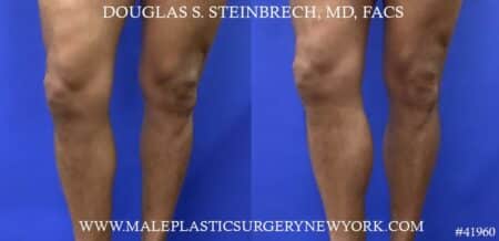 Calf implants to enhance the lower leg by Dr. Steinbrech