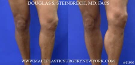 Calf implants to enhance the lower leg by Dr. Steinbrech