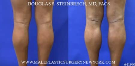 Calf implants to enhance the lower leg by Dr. Steinbrech