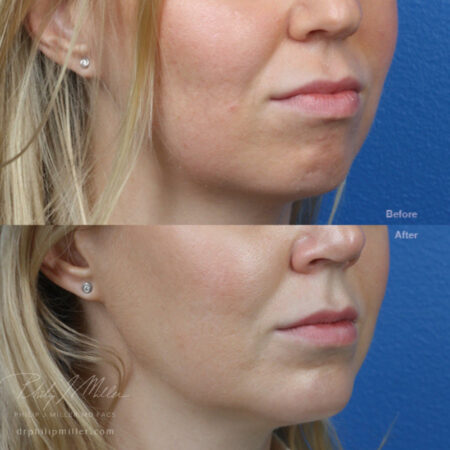 Implant to increase the projection of the chin by Dr. Miller