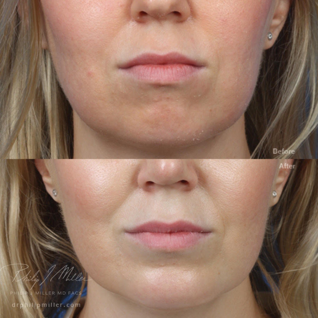 Implant to increase the projection of the chin by Dr. Miller. After surgery, chin is more prominent and proportionate to the rest of the face.