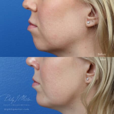 Implant to increase the projection of the chin by Dr. Miller