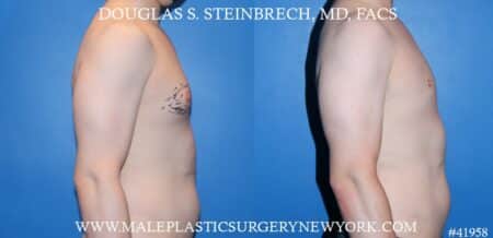 Gynecomastia treatment to enhance the appearance of the chest by Dr. Steinbrech