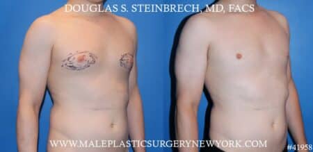 Gynecomastia treatment to enhance the appearance of the chest by Dr. Steinbrech