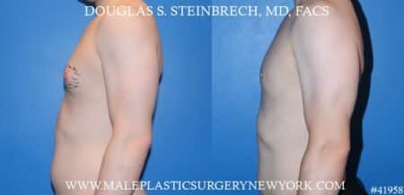 Gynecomastia treatment to enhance the appearance of the chest by Dr. Steinbrech