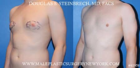 Gynecomastia treatment to enhance the appearance of the chest by Dr. Steinbrech