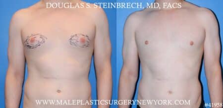 Gynecomastia treatment to enhance the appearance of the chest by Dr. Steinbrech