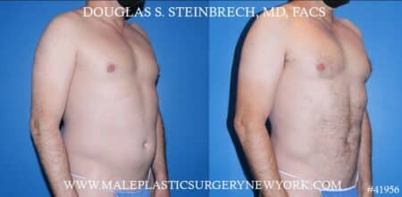 Liposuction with body banking to augment the pecs by Dr. Steinbrech